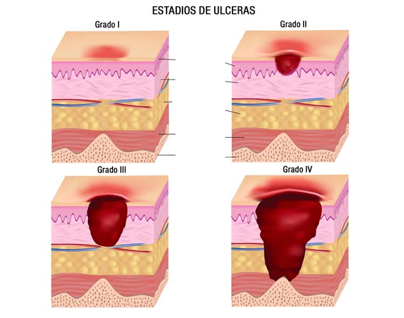 Grados de las úlceras sacras