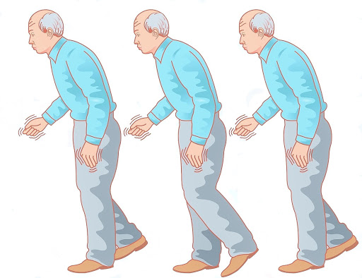 Síntomas del Parkinson en personas mayores de 50 años